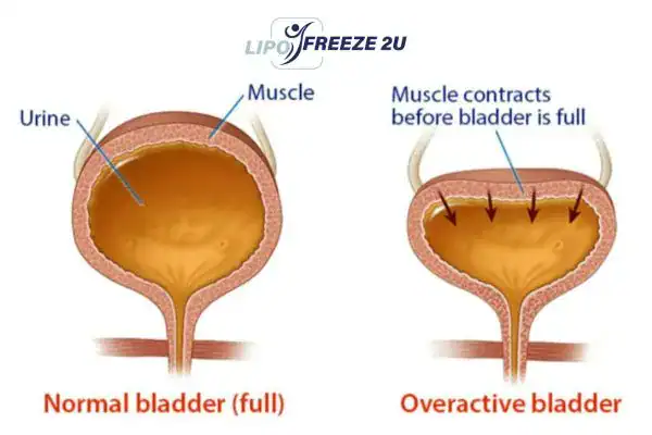 diagram of overactive bladder treatment Oakham