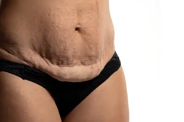 loose skin after weight loss injections Oakham