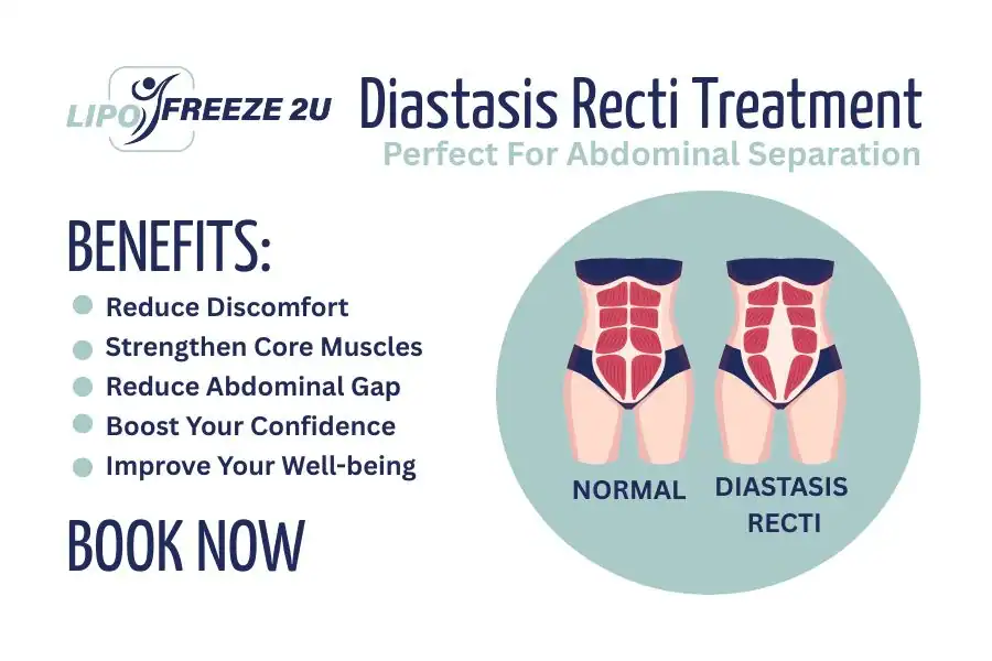 How Long Will It Take to See Improvements in Diastasis Recti Oakham
