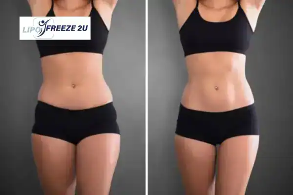 How Can LIPO FREEZE 2U Support Your Post-Pregnancy Body Recovery Oakham?