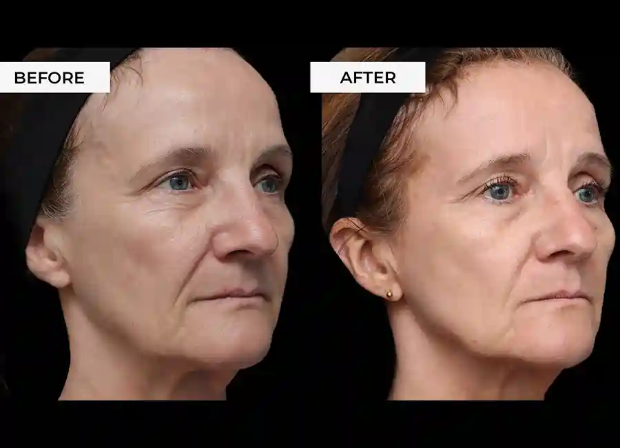 How Many RF Microneedling Sessions Will You Need to See a Difference Oakham?