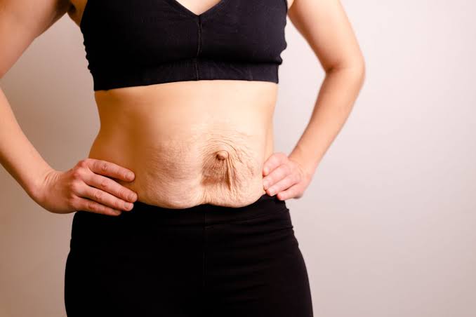 Is Surgery Really the Only Way to Repair Diastasis Recti Oakham?